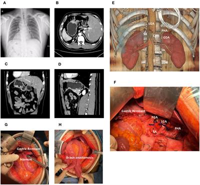 Gastric adenocarcinoma in Situs inversus totalis: a case study and literature review